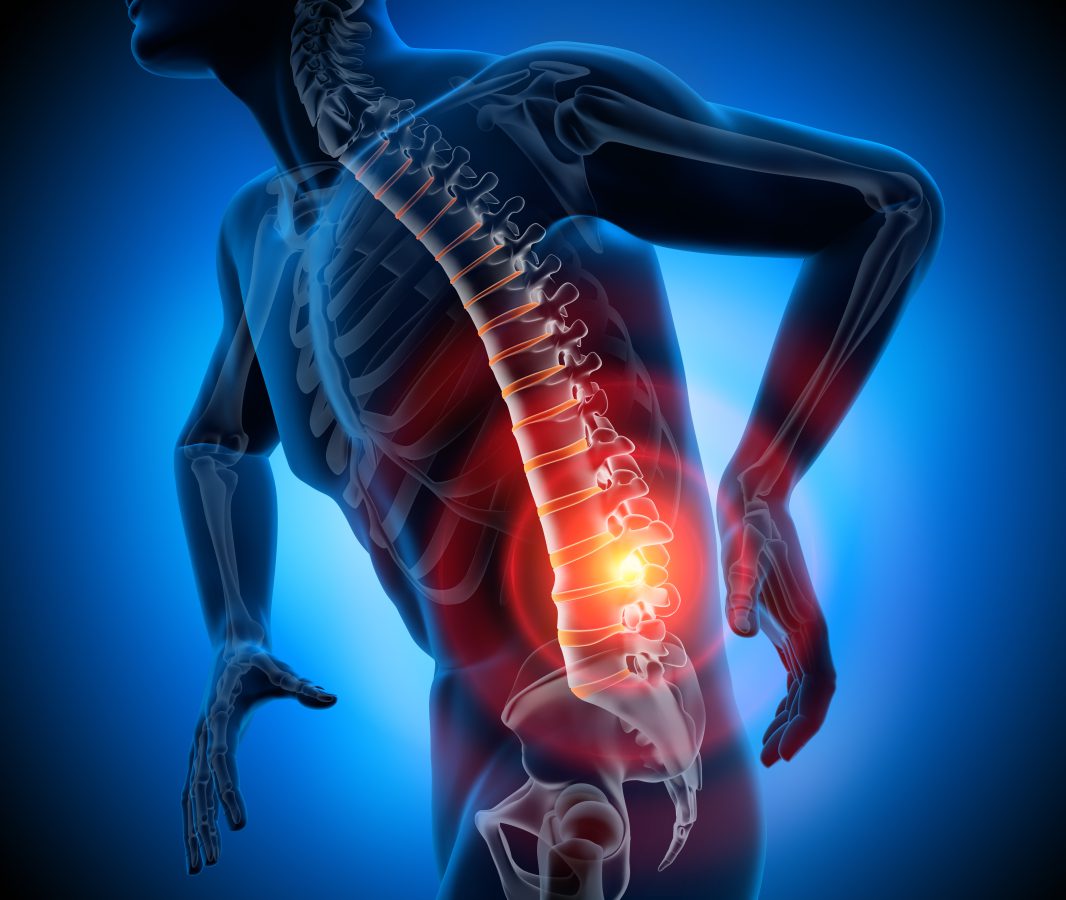 Sciatica